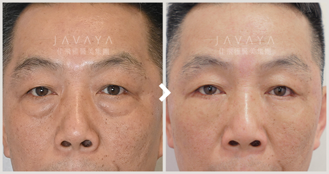 隱痕眼袋手術案例